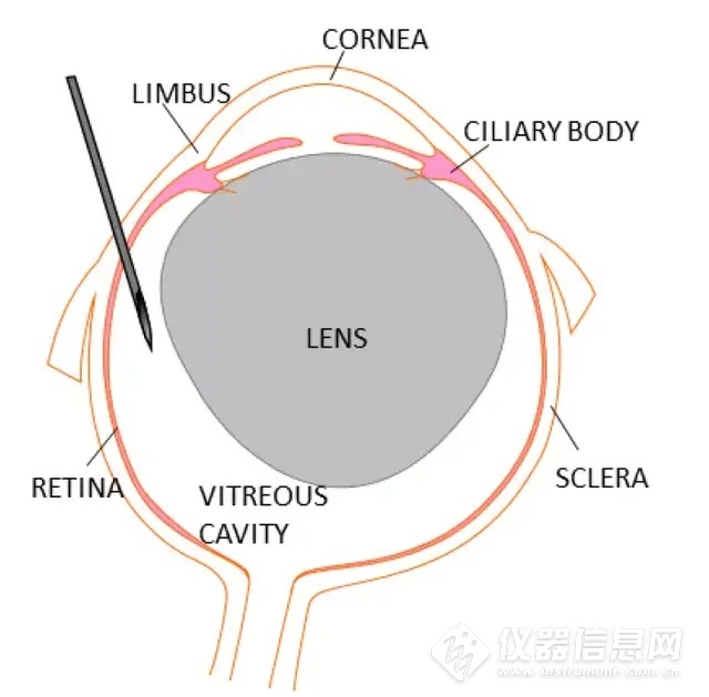 玻璃体腔注射进针示意图 玻璃体腔注射进针示意图