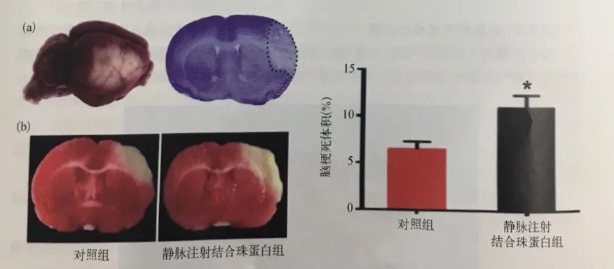 大脑中动脉远端阻塞后梗死部位检测 大脑中动脉远端阻塞后梗死部位检测