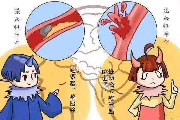 脑卒中类型 脑卒中类型