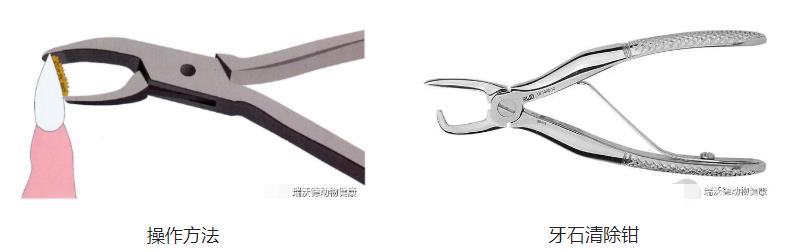 大块牙结石去除 大块牙结石去除