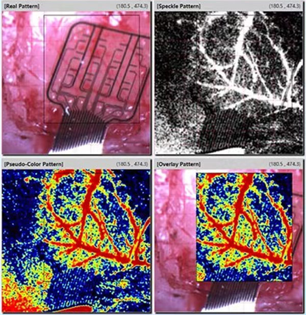 必威官方首页官网betway激光散斑血流成像系统使用分享