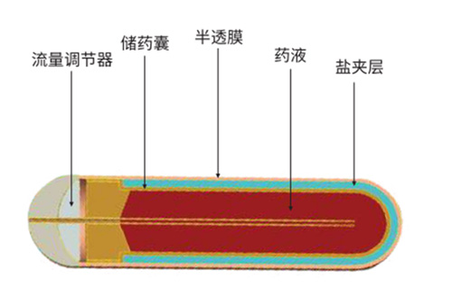 植入式缓释泵时常见的问题